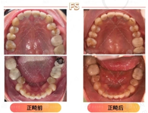 巩玉花医生做正畸的真实<span style=