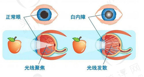 白内障手术前后注意事项有哪些