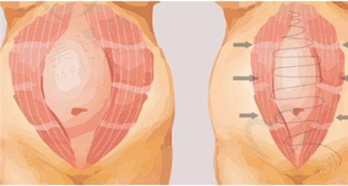 广州高尚做腹壁整形手术怎么样