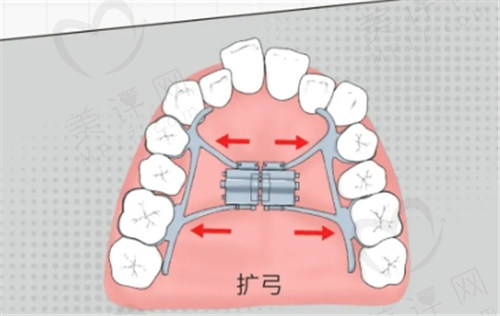 扩弓矫正对脸型有影响吗？