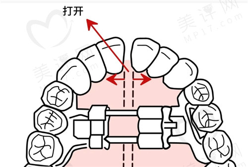 快速扩弓和慢速扩弓有什么区别？