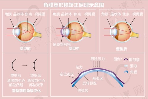 戴眼镜和眼角膜塑型哪个好