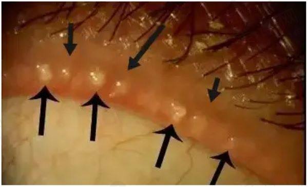 睑板腺功能障碍是什么