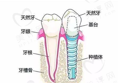 瑞士SIC种植体和ITI哪个好？