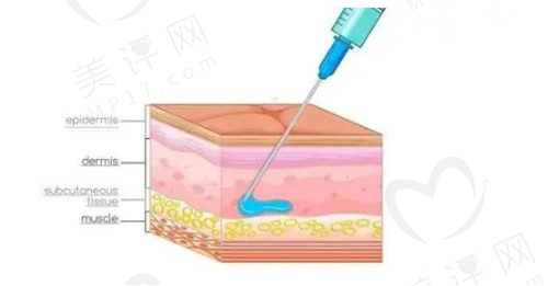 南京艺星医疗美容玻尿酸注射口碑好