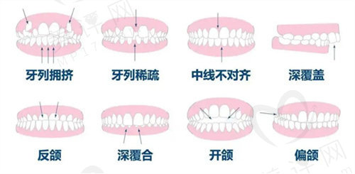 正雅GS版矫正<span style=