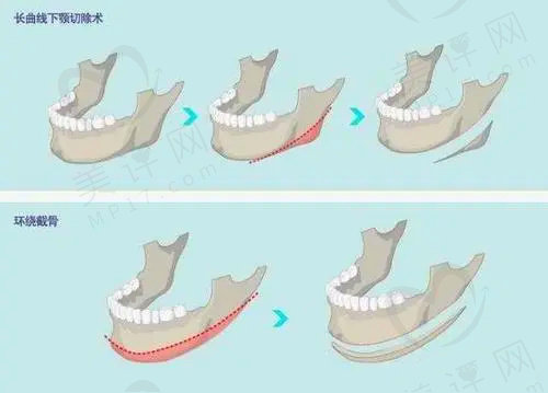 广西南宁爱思特整形外科医院的正颌手术好