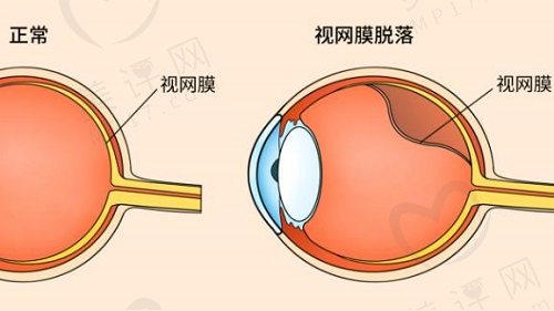 视网膜脱落有什么症状表现