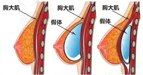 隆胸假体植入方式