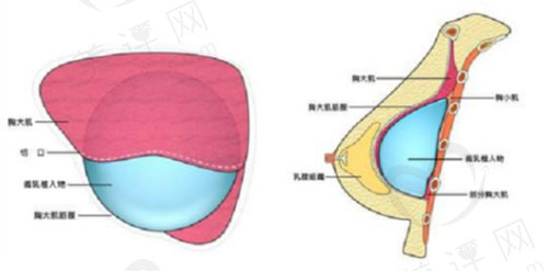 假体隆胸手术价格多钱？