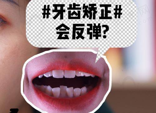 牙齿矫正会反弹？