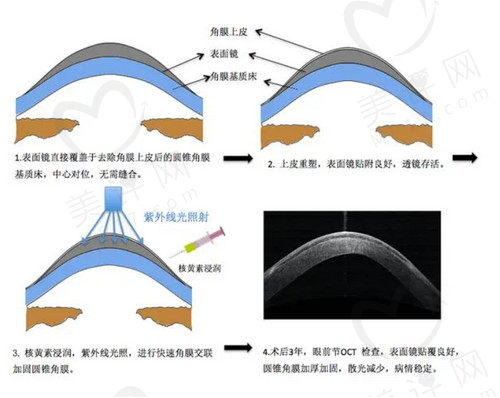 角膜胶原交联手术多少钱