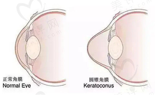 角膜交联术用医疗保险报销吗