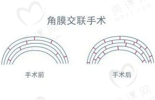 角膜交联手术原理