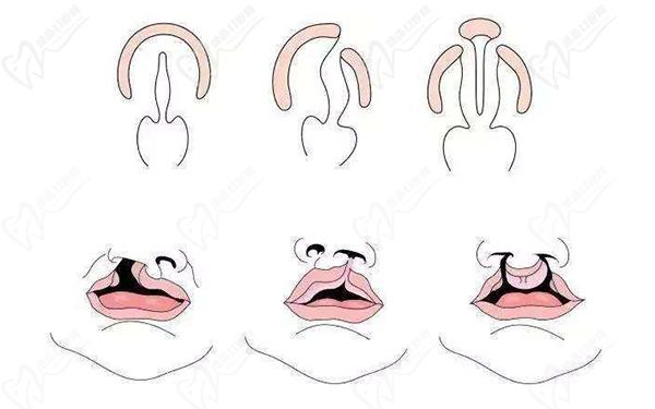 陈国鼎唇裂修复效 果图实例