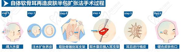 北京丽都耳再造中心耳再造技术