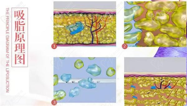 吸脂原理