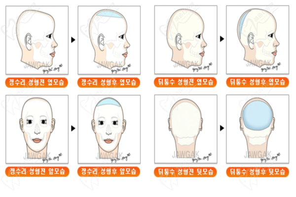 骨水泥高颅顶的真实感受