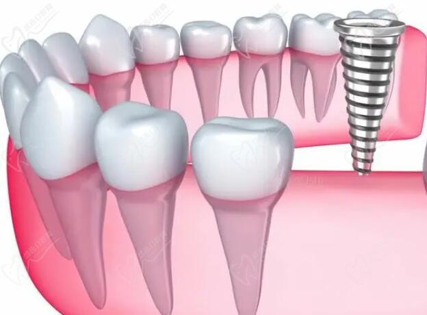 种植牙多少钱一颗2023年广 东