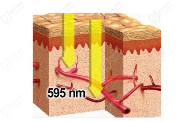 595染色激光纳米声波