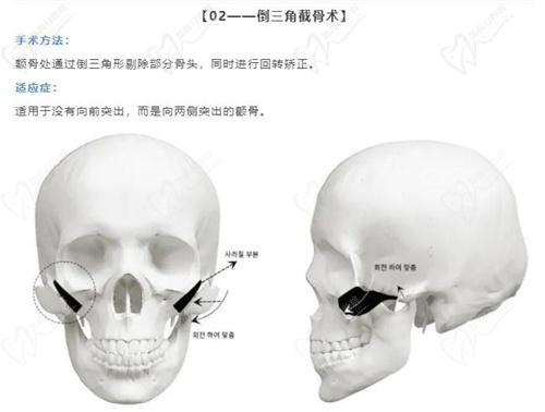 韩国伊美芝做轮廓怎么样