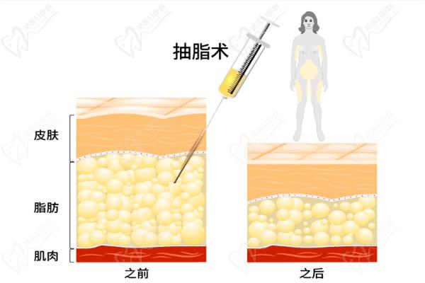 郑大一附院整形科吸脂