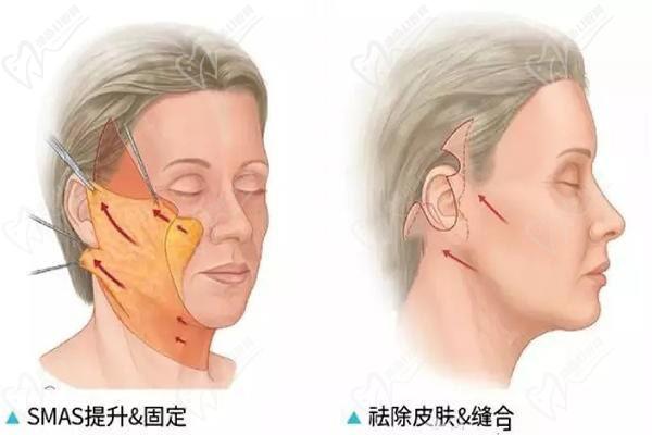 国内面部提升技术蕞好的医生名单