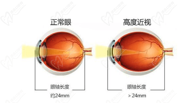 北京晶体植入手术近半年价格走势