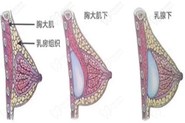 北大医学院胸部整形价格表