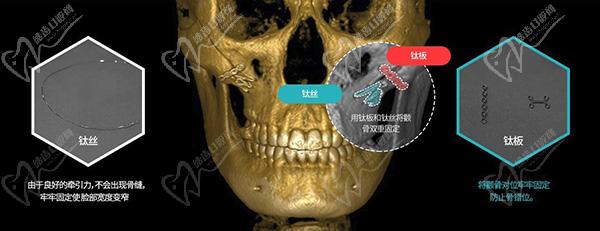 双重固定颧骨缩小术是韩国ts整形外科特有的技术