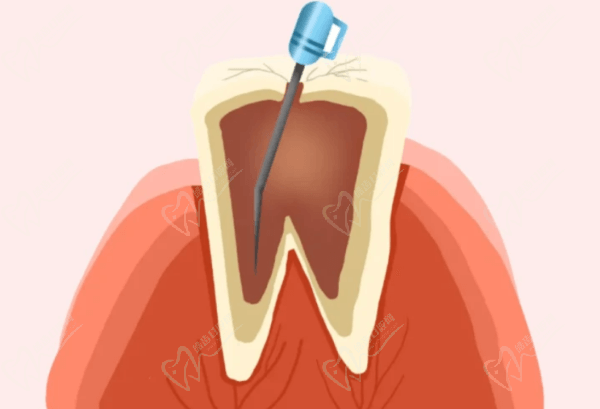 根管治疗