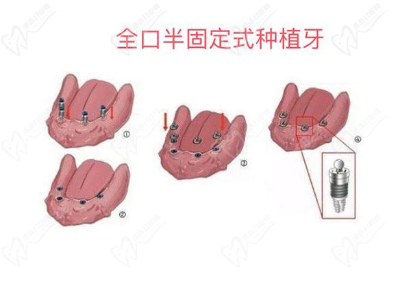 全口半固定式种植牙