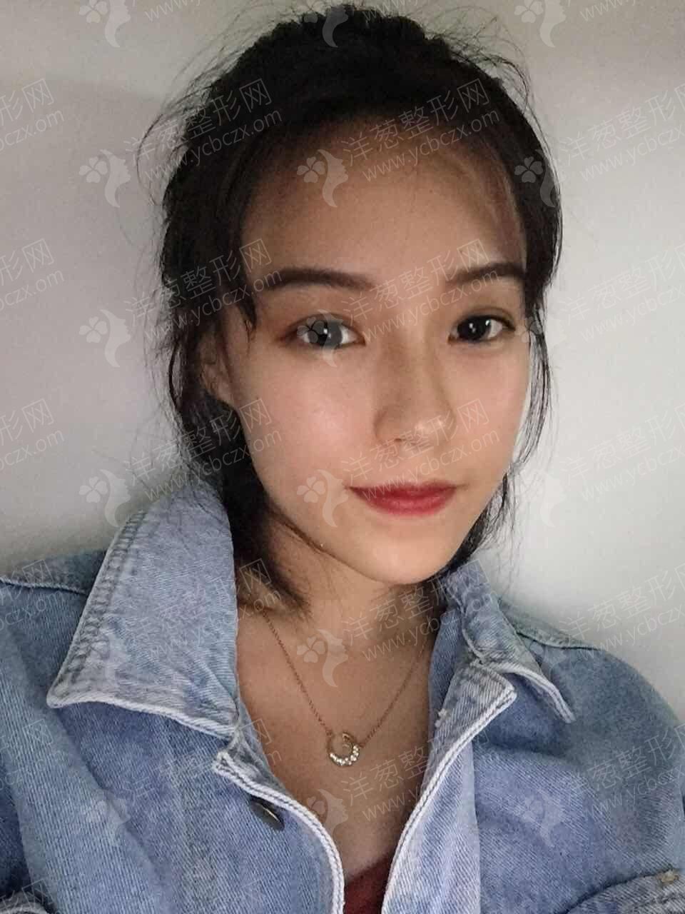 术后.jpg