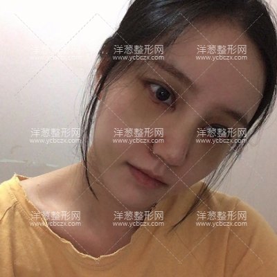 西安致美霍玉旺隆鼻技术怎么样假体隆鼻案例前后对比图分享